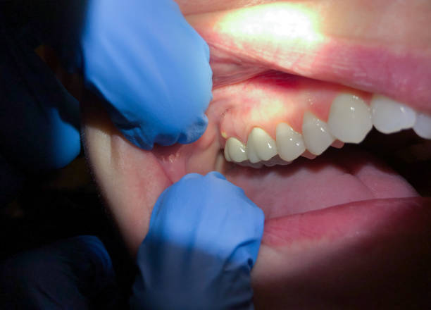 Best Chipped Tooth Repair Near Me  in Fairfax, CA